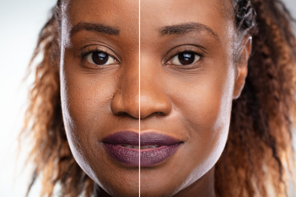 Close-up,Of,A,Young,Woman's,Face,Before,And,After,Cosmetic