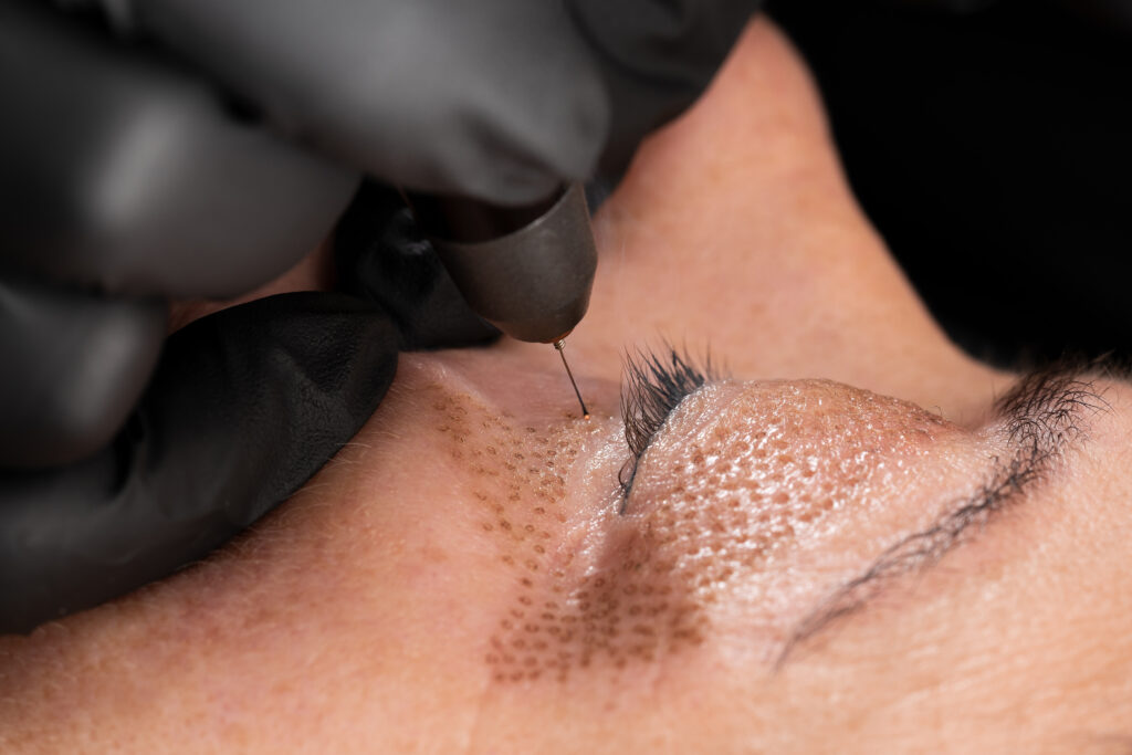 Women,Eyelid,Lifting,,Fibroblast,Procedure.