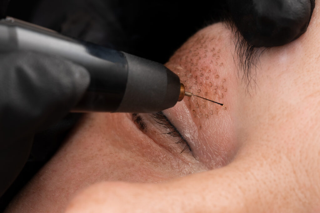 Women,Eyelid,Lifting,,Fibroblast,Procedure.