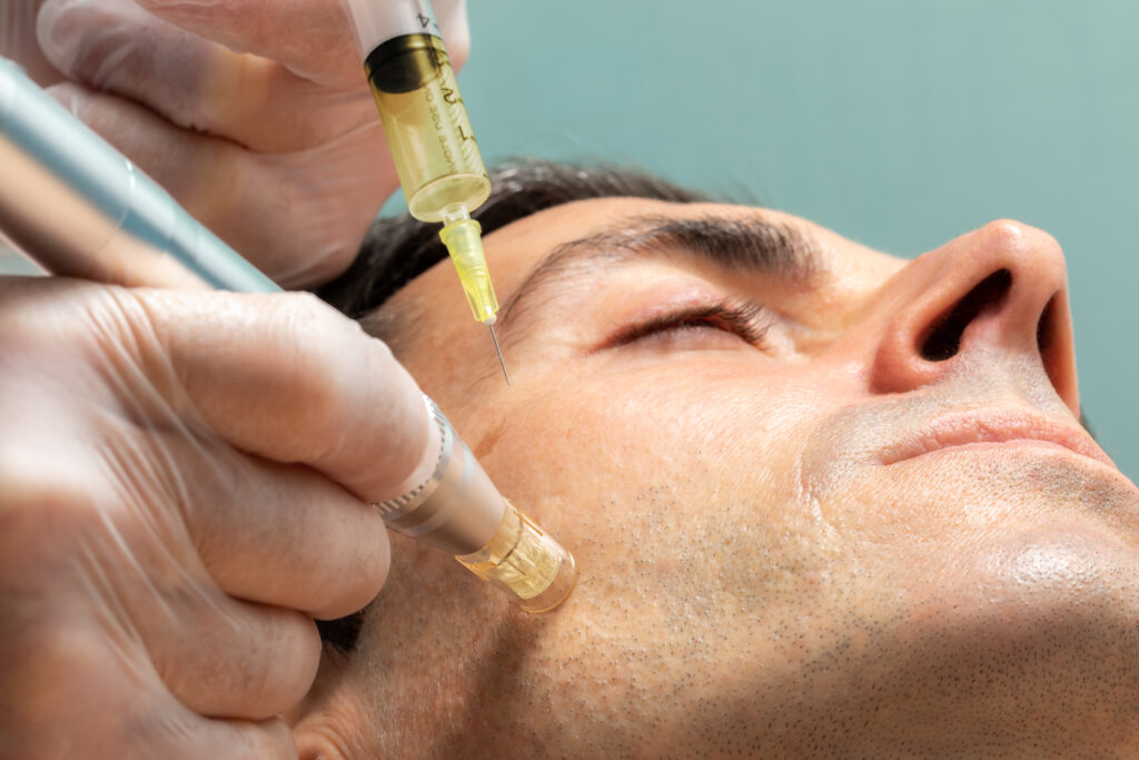 Macro,Close,Up,Of,Therapist,Injecting,Enzymes,On,Cheek,With