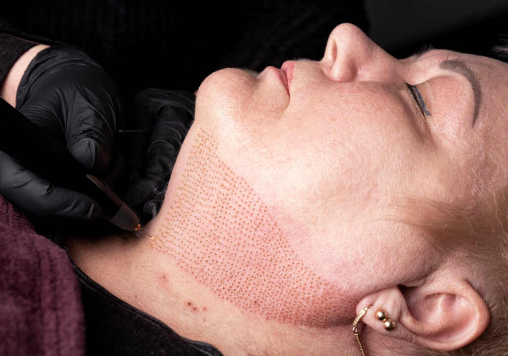 Fibroblast,,Plasmalifting,Procedure,Womens,Neck,Wrinkles,Lifting
